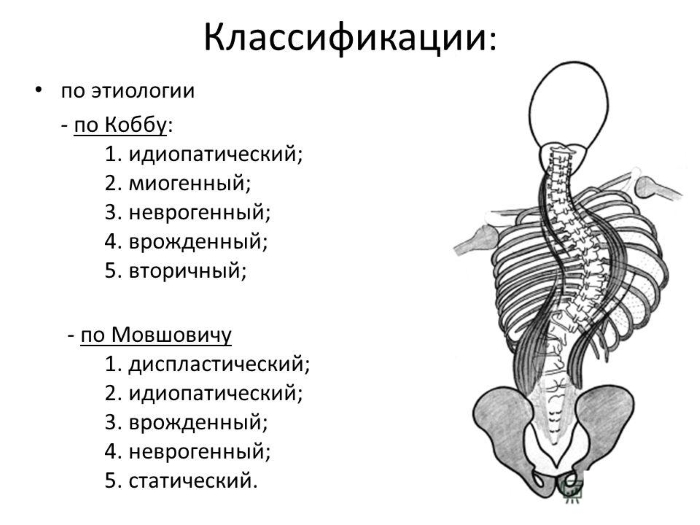 Классификации сколиоза по Коббу и Мовшовичу