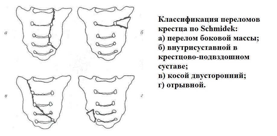 Классификация переломов крестца по Шмидек