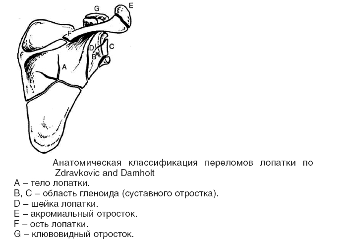 Классификация переломов лопатки