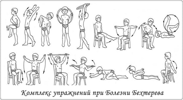 Комплекс упражнений при болезни Бехтерева