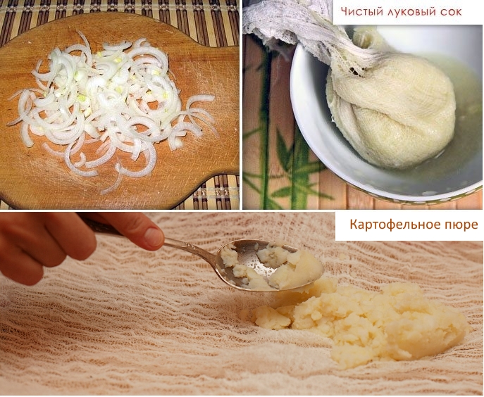 Компрессы с луком и картофелем
