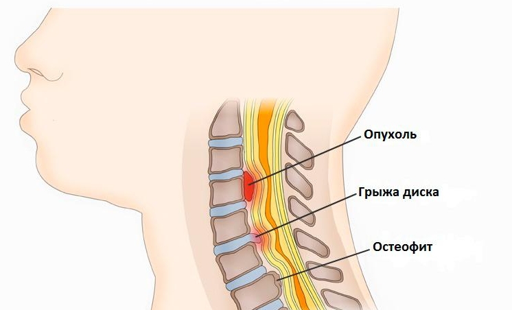 Компрессионная миелопатия