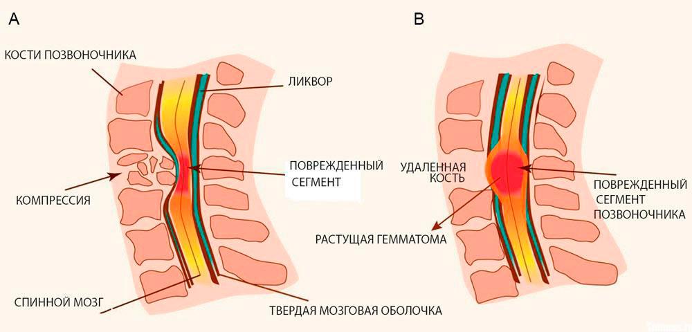 Компрессия спинного мозга