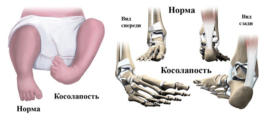 Косолапие у детей