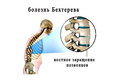 Костное заращение позвонков при спондилите