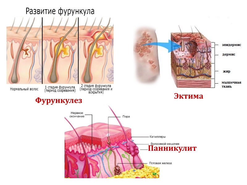 Возможные кожные заболевания на ягодицах