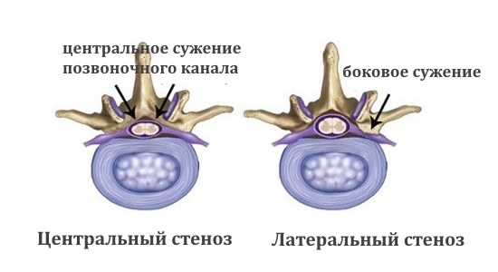 Центральный и латеральный стеноз