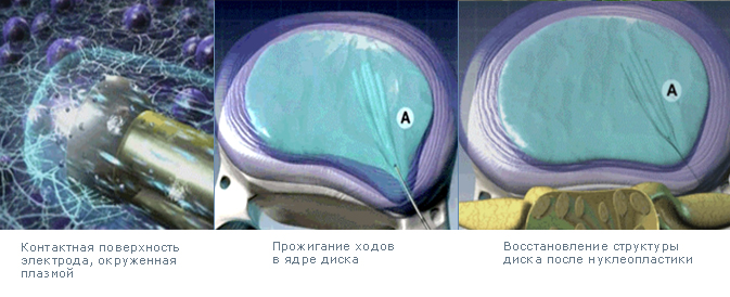Лазерная нуклеопластика