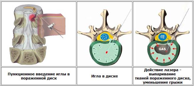 Лазерное лечение межпозвоночной грыжи