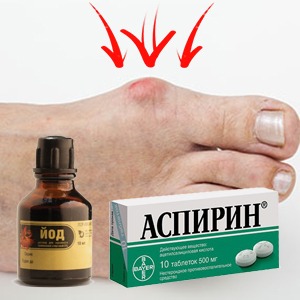 Лечение подагры на ногах аспирином и йодом