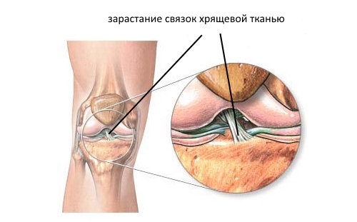 Зарастание связок хрящевой тканью