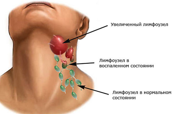 Лимфаденит