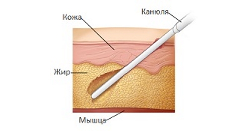 Липосакция 