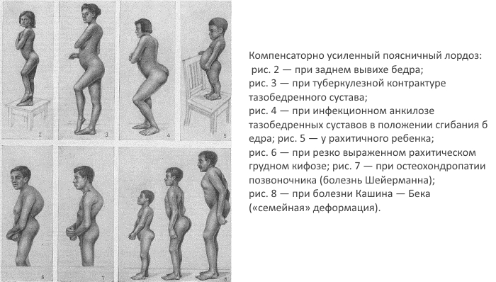 Компенсаторный лордоз