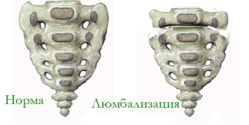 Двусторонняя люмбализация 