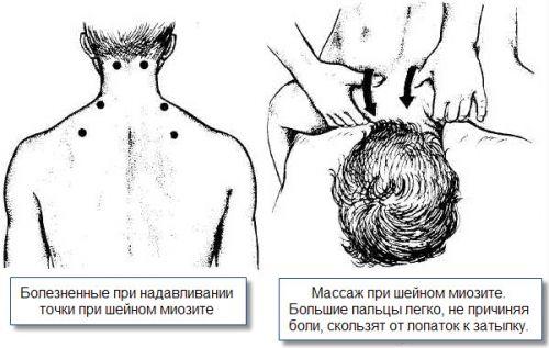 Массаж шеи при миозите