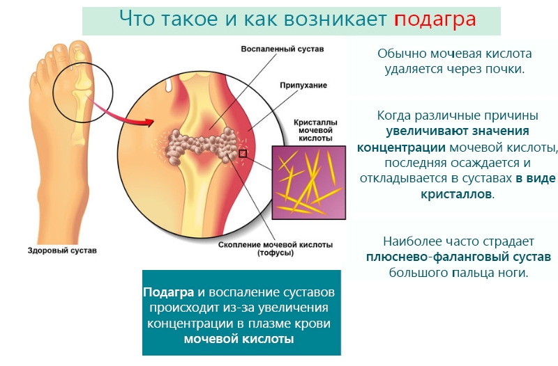 Механизм образования подагры