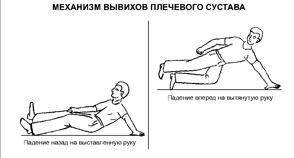 Механизм появления вывиха плеча
