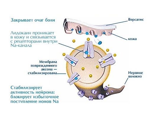 Механизм действия пластыря при остеохондрозе