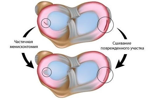 Менискэктомия и сшивание
