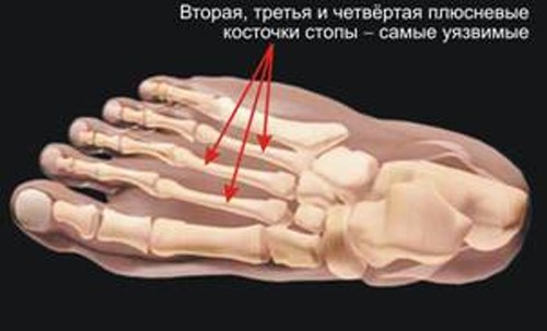Места маршевых переломов костей