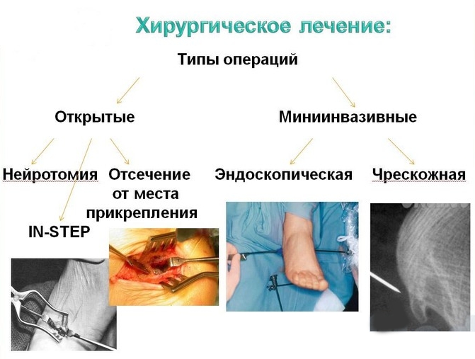 Методы хирургического удаления пяточной шпоры