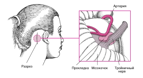 Микроваскулярная декомпрессия