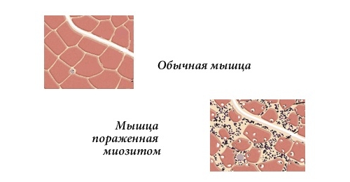 Миозит мышц