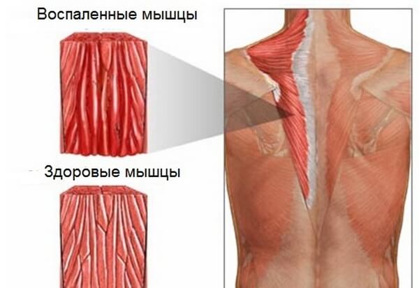 Миозит мышц спины