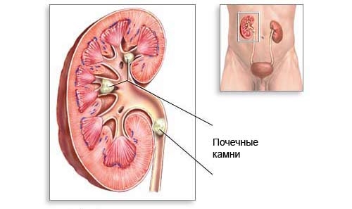 Мочекаменная болезнь