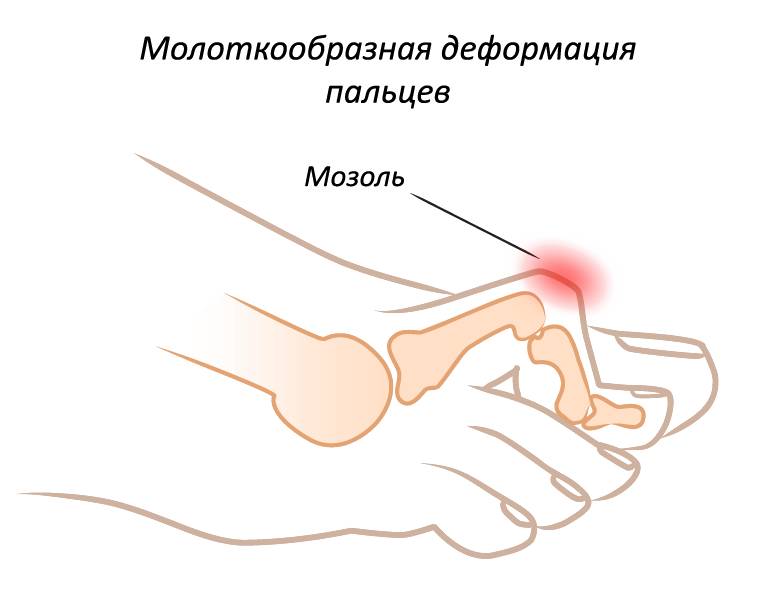 Мозоль из-за деформации большого пальца стопы