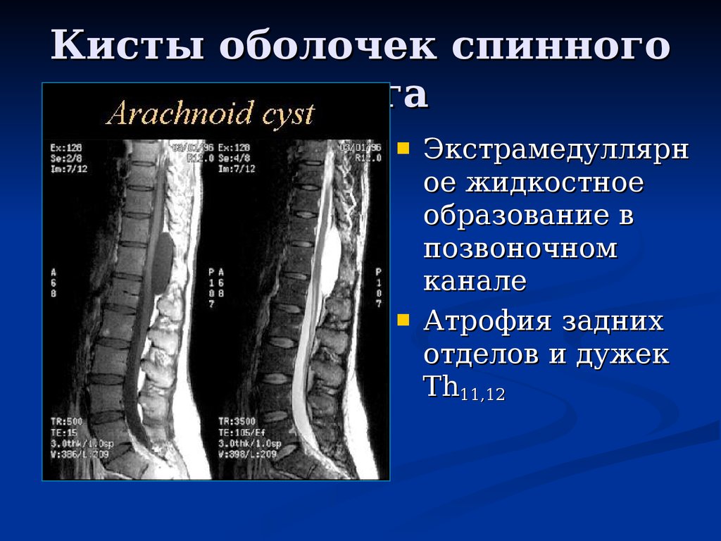 МРТ диагностика кист позвоночника