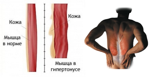 Калмирекс при мышечном гипертонусе и спазме