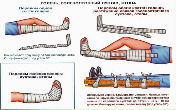 Наложение шины при переломе голеностопа