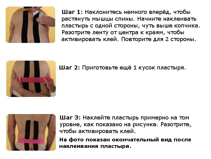 Наложение тейпов при грыже позвоночника