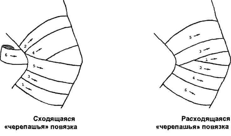 Наложение тугой повязки на колено