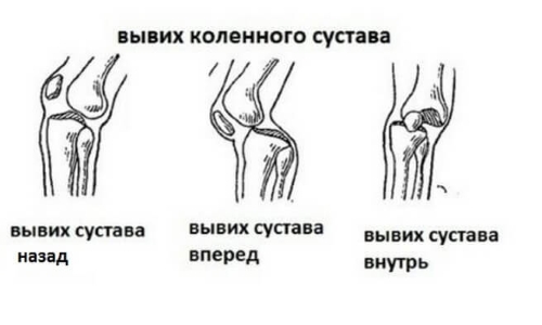 Направление вывиха коленного сустава