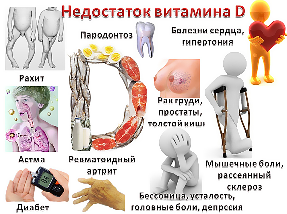 Болезни при недостатке витамина Д