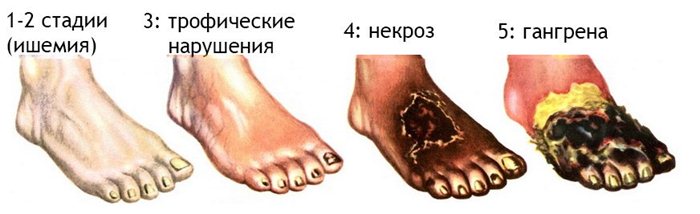 Развитие гангрены на фоне некроза