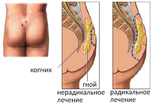 Нерадикальное и радикальное иссечение кисты