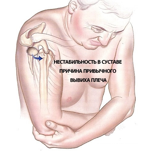 Неестественное положение плеча