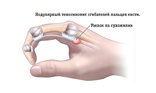 Нодулярный теносиновит