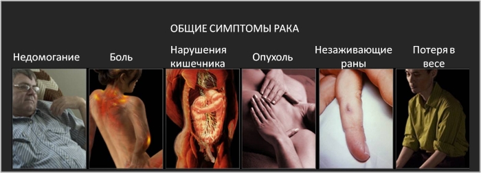 Общие симптомы рака