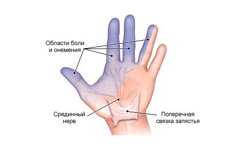 Онемение в руке