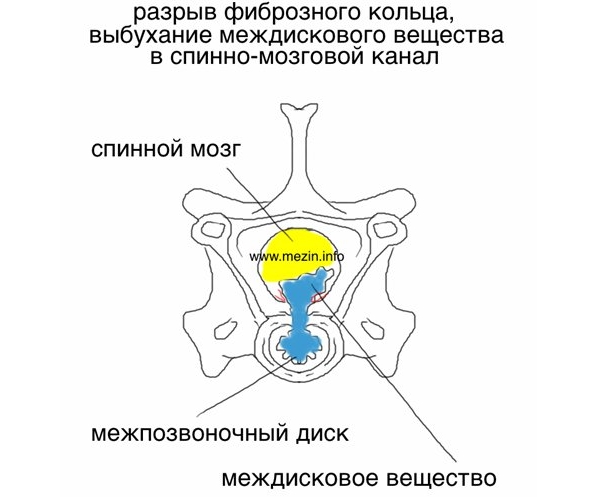 Опасность разрыва фиброзного кольца