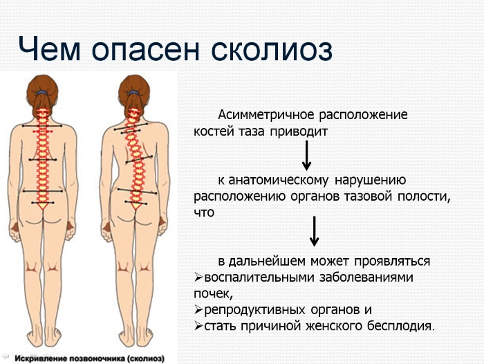 Опасность сколиоза