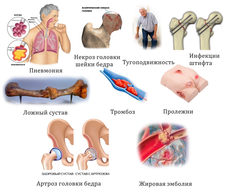 Опасные последствия перелома шейки бедра