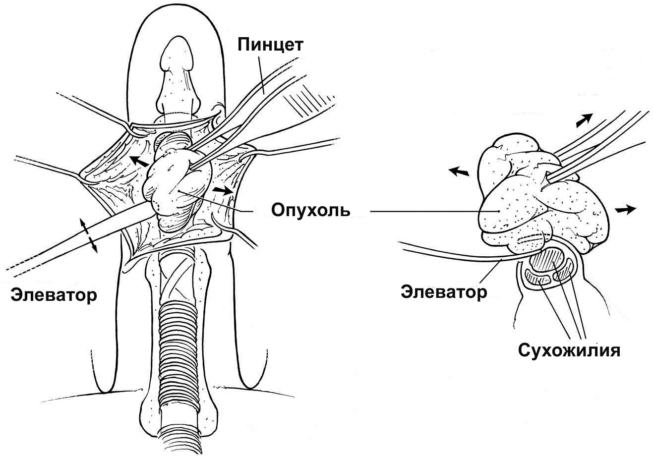 Оперативное лечение синовиомы