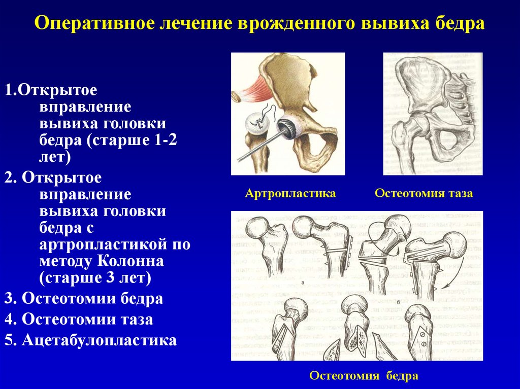 Оперативное лечение врожденного вывиха бедра