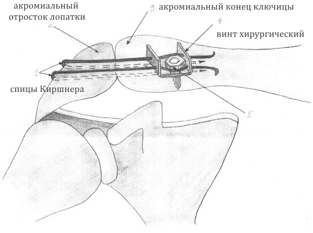 Оперативное лечение ключицы